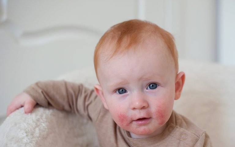 Managing Baby Allergies and Sensitivities: A Parent’s Essential Guide