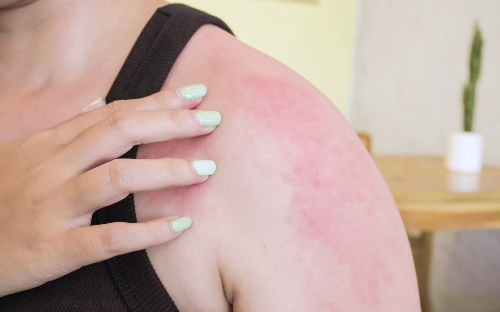 What to Do If You Get a Sunburn During Pregnancy